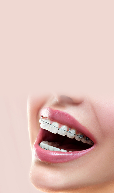 Ceramic Braces