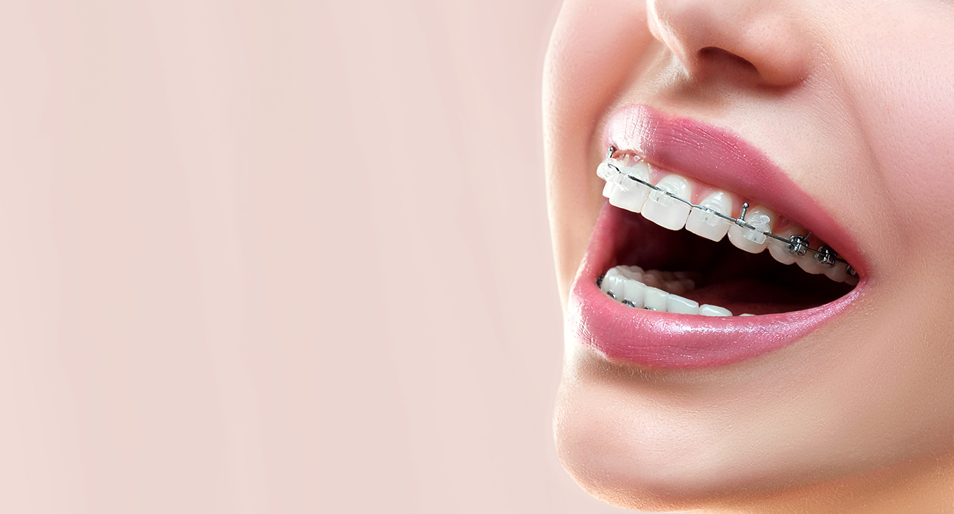 Ceramic Braces