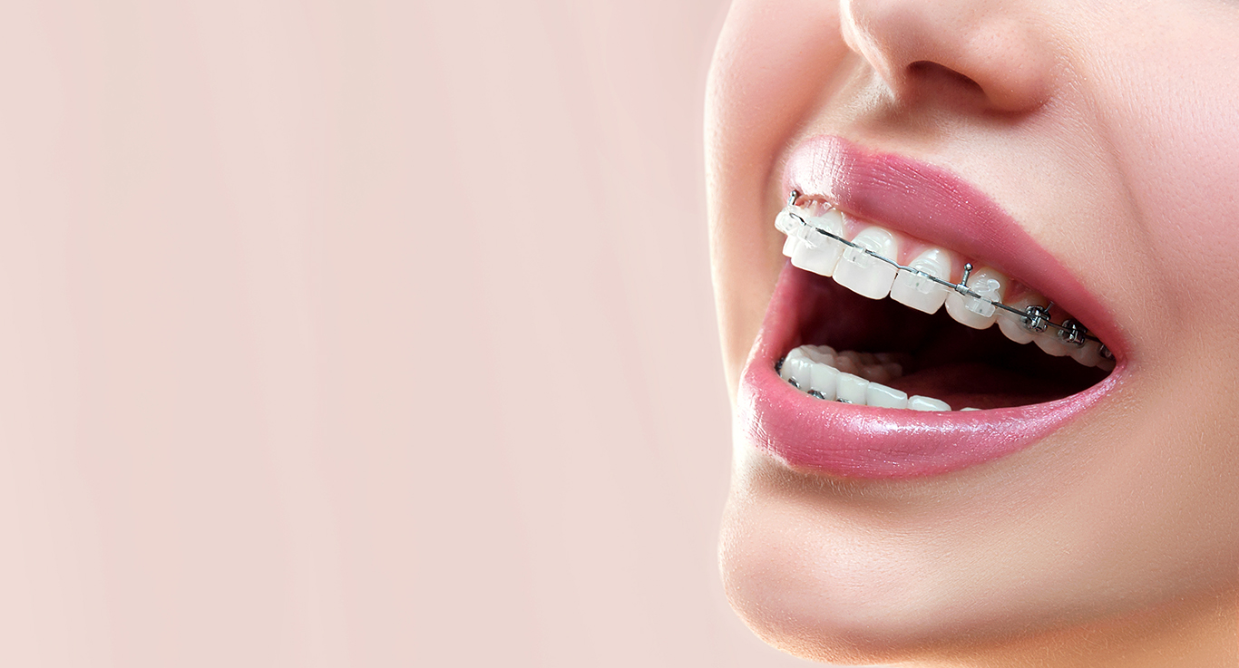 Ceramic Braces