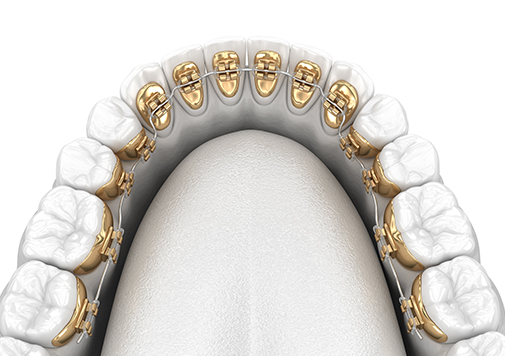 Invisible Lingual Braces