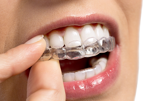 Invisalign Clear Aligners