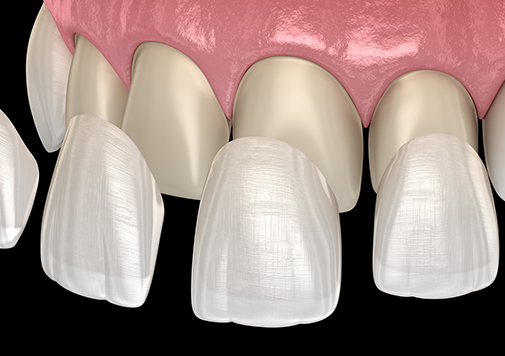 Dental Veneer