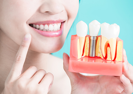 Dental Implants In Mirdif