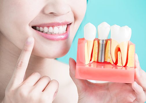 Dental Implants