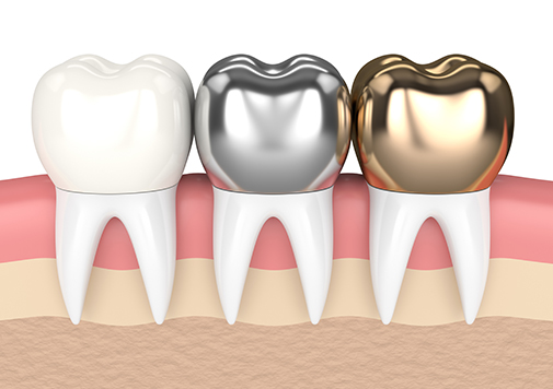 Dental Crowns