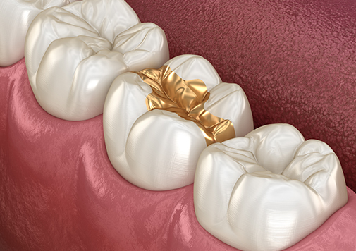 Gold Fillings