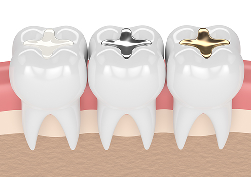 Restorations / Tooth Fillings