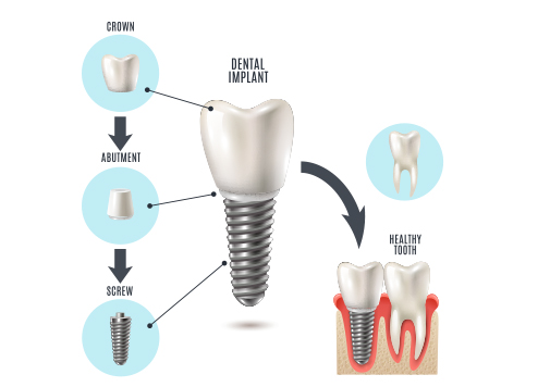 Dental Implants