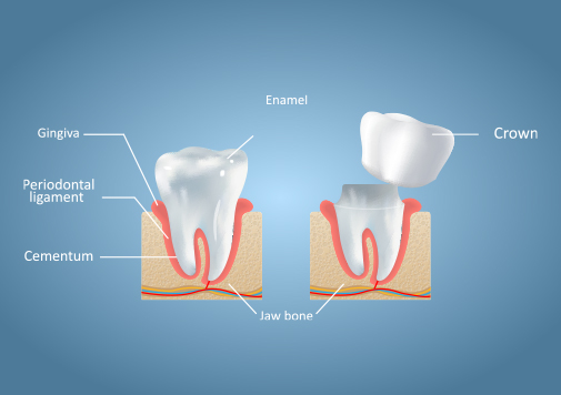 Dental Crowns