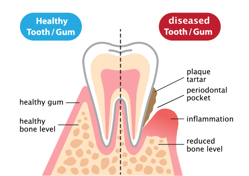 Gingivitis/Periodontitis