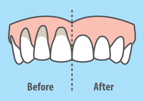 Gum Recession