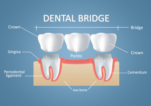 Dental Bridges