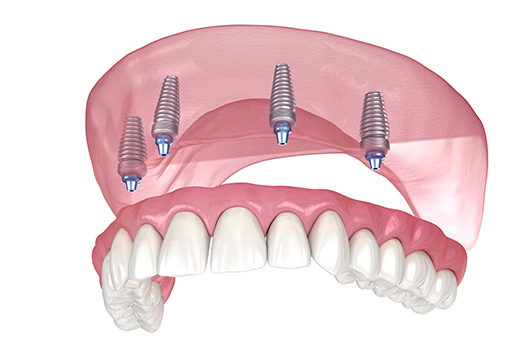 Dentures