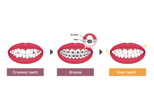 Metal Braces