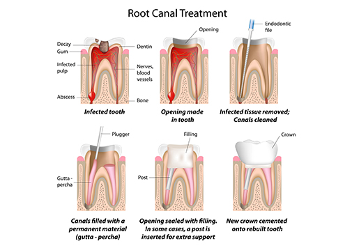 Root Canal Treatment