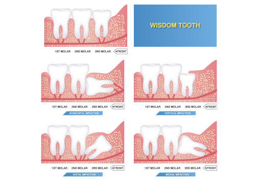 Wisdom Tooth Extraction