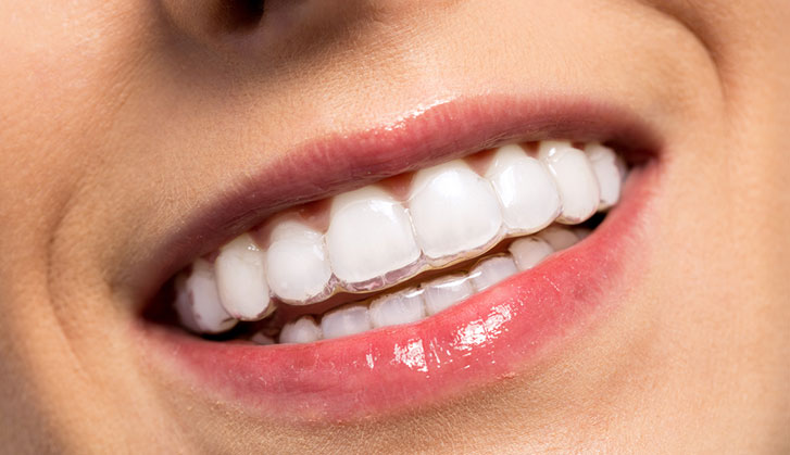 The benefits of space maintainers and clear braces in preventing dental  issues