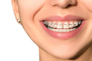 Fixing Teeth Gaps