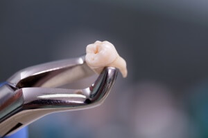 Wisdom tooth removal in dubai