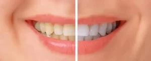 teeth whitening difference
