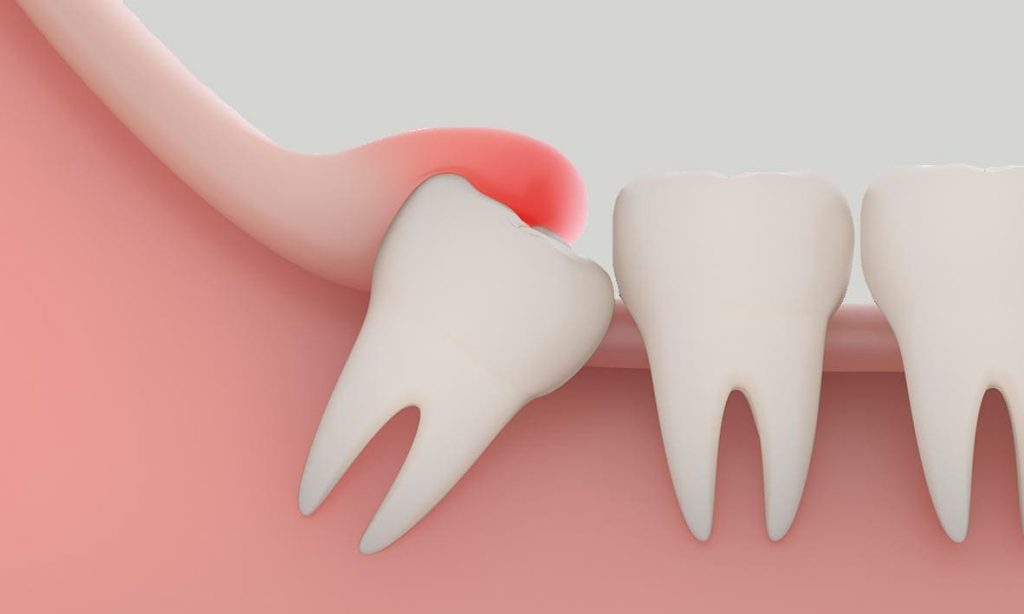 pericoronitis-teeth