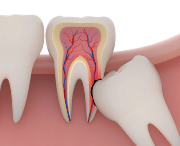 adjacent-teeth