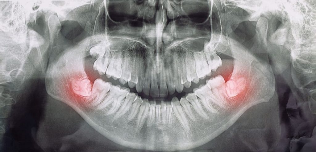 wisdom-tooth-alignment