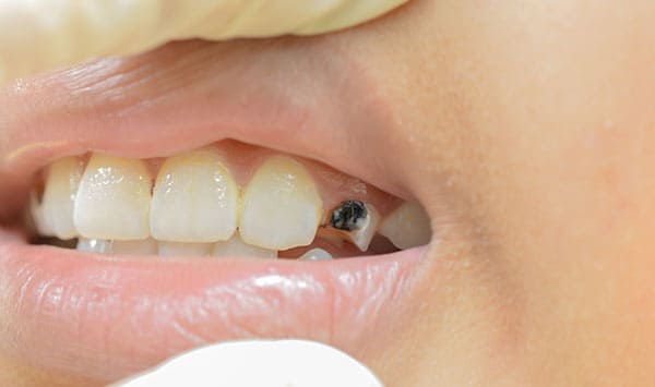 tooth-cavity