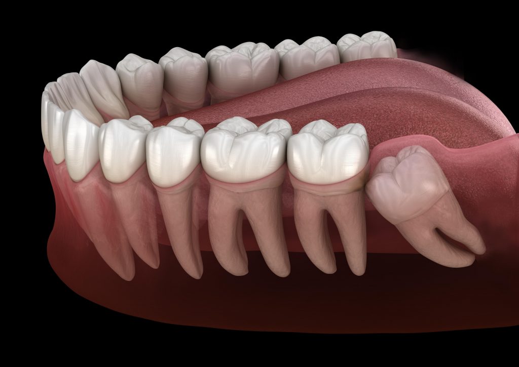 tooth-impaction