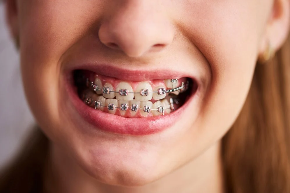 Braces styles 