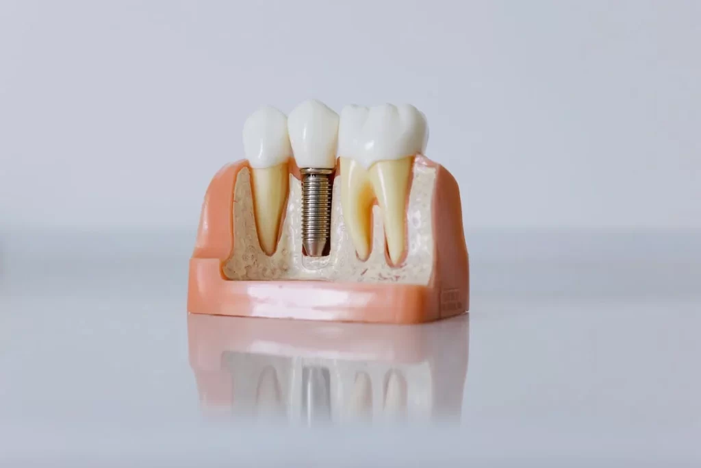 Dental implants vs dentures