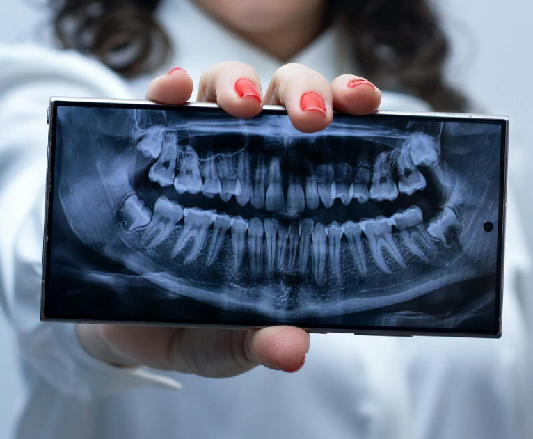 Wisdom Tooth Extraction Process in Dubai