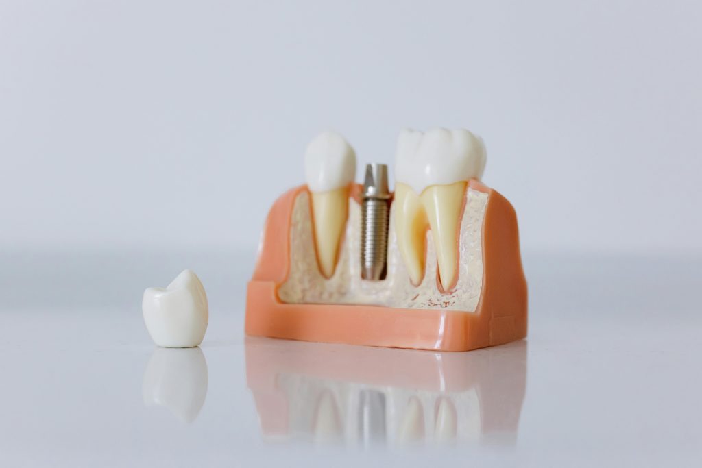 Close-up view of a medical-grade titanium dental implant