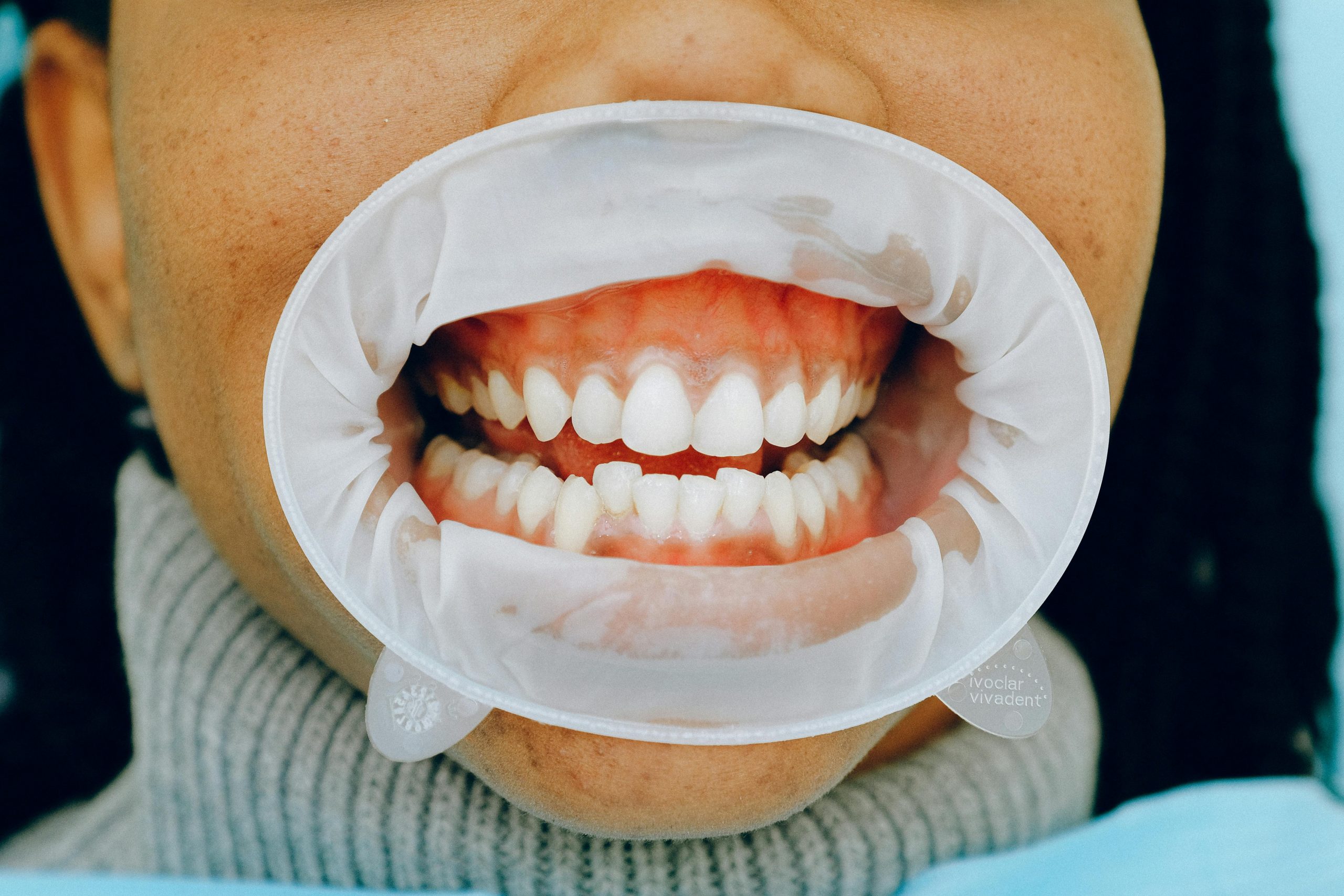 Gum Health Warning Signs